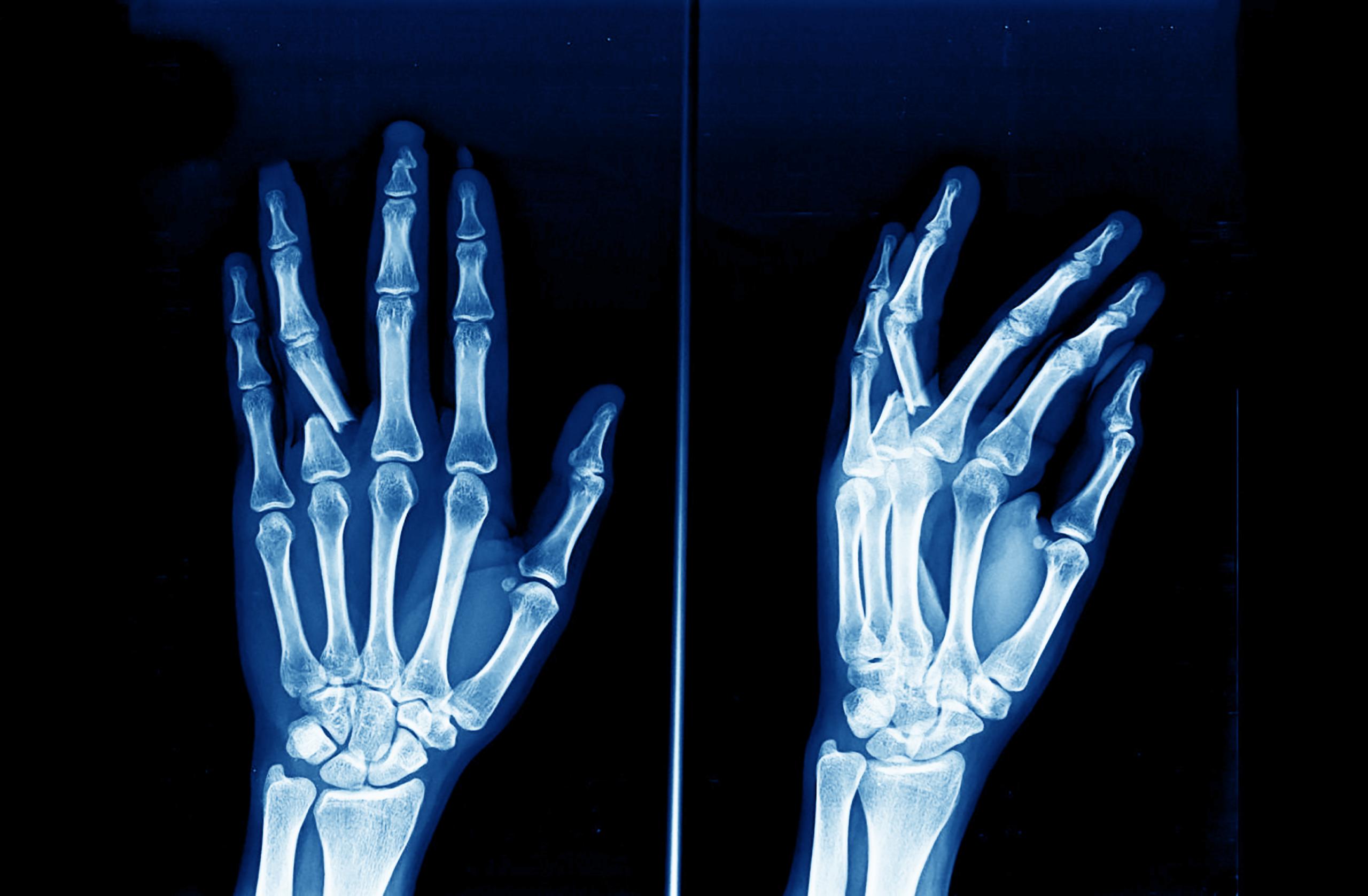 Fractures And Dislocations Reconstructive Plastic Surgery Melbourne