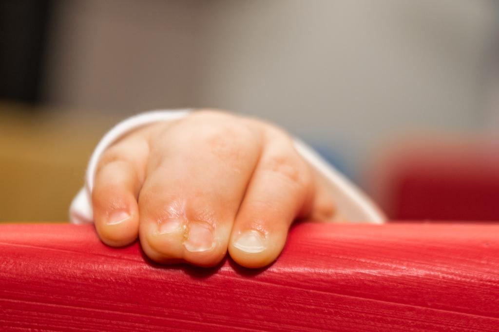 Close,up,of,baby,girl,hands,,with,syndactyly.,medical,condition,